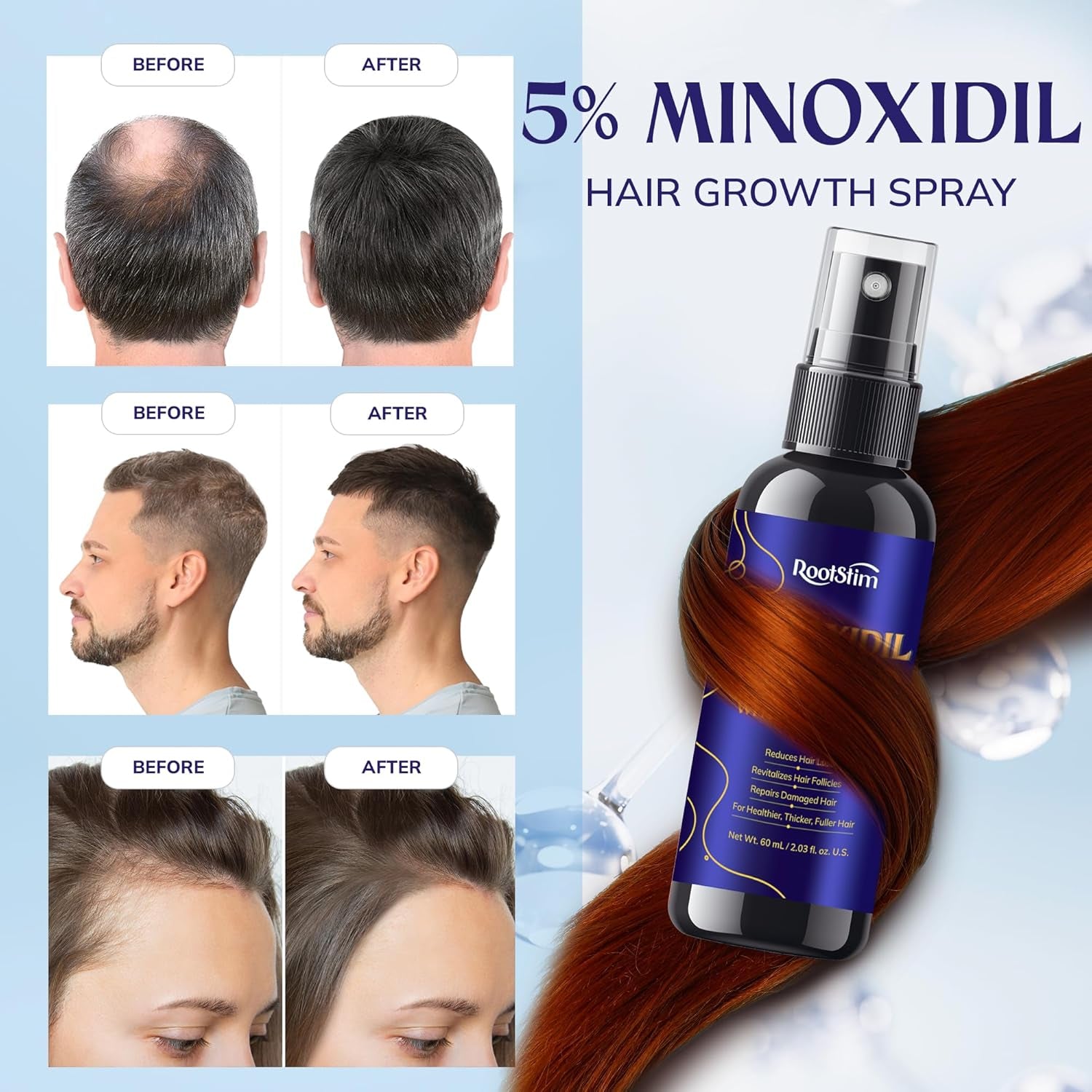 5% Minoxidil Hair Growth for Men and Women: 2-Pack Extra Strength Minoxidil Hair
